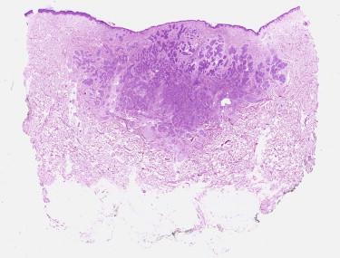 FIGURE 11-26, Basal cell carcinoma, micronodular pattern. The tumor is composed of multiple small nodular aggregates of basaloid cells.