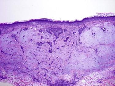 FIGURE 11-27, Basal cell carcinoma, infiltrative pattern. Thin cords and oddly shaped aggregates of tumor cells are dispersed in a haphazard infiltrative pattern.