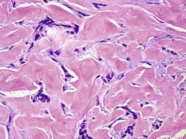 FIGURE 11-28, Morpheaform basal cell carcinoma (BCC). This BCC shows an infiltrative growth pattern. Basaloid cords and strands are set in a densely fibrotic stroma.