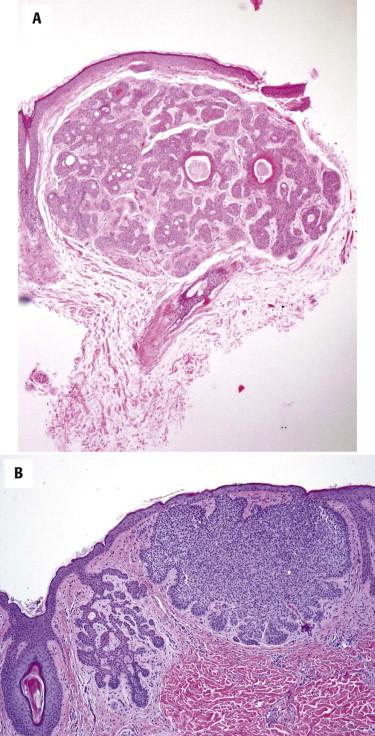 FIGURE 11-30, Infundibulocystic basal cell carcinoma (BCC). A, A small nodule of cytologically bland basaloid cells is present with small keratocysts. B, A small hamartomatoid BCC component adjacent to a conventional BCC.