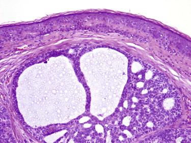 FIGURE 11-31, Basal cell carcinoma with adenoidal features. Within the tumor nodule, a cribriform architecture is apparent.