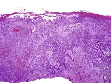 FIGURE 11-33, Basal cell carcinoma with squamous differentiation (metatypical basal cell carcinoma). Parts of the tumor cell population have a pinker cytoplasm and are keratinizing.