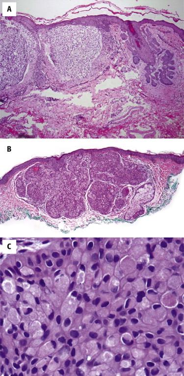 FIGURE 11-34, Basal cell carcinoma (BCC) with clear cell or granular cytoplasm. A, Part of this BCC shows a clear glycogenated cytoplasm. B, Granular cell variant of BCC with a pink appearance. C, The tumor cells have a granular cytoplasm.