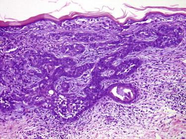 FIGURE 11-35, Basal cell carcinoma (BCC) engulfing an eccrine duct. BCCs may contain ductal structures. Usually, as in this case, they are engulfed by the tumor, but occasionally, the tumor may show ductal differentiation.