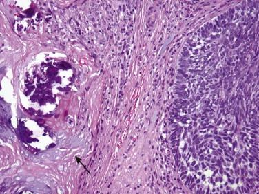 FIGURE 11-36, Basal cell carcinoma (BCC) with matrical differentiation. A nodular BCC shows a focus of shadow cells (arrow).