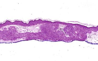 FIGURE 11-4, Tumor of follicular infundibulum (infundibuloma). Aggregates of small keratinocytes show multiple connections to the epidermis and form a superficial dermal plaque.