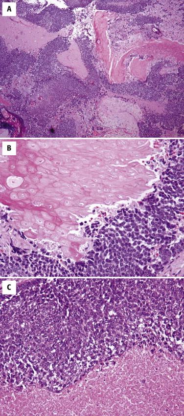 FIGURE 11-41, Pilomatrix carcinoma. A, Sheets of basaloid tumor cells. B, The basaloid cells have a round, oval, or cuboidal appearance. They are juxtaposed to shadow cells. C, An area of necrosis is seen.