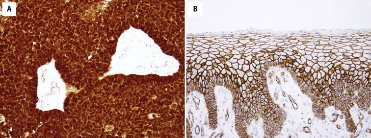 FIGURE 11-42, A, Nuclear and cytoplasmic staining for β-catenin in pilomatrix carcinoma. B, Normal epidermis shows a membranous staining pattern.