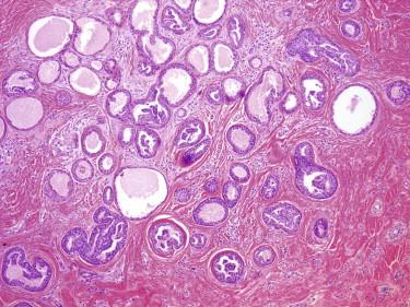 FIGURE 11-43, Eccrine adenoma. This adenoma shows a tubular and papillary pattern. The ductal structures are lined by two cell layers of inner duct epithelial and outer myoepithelial cells.