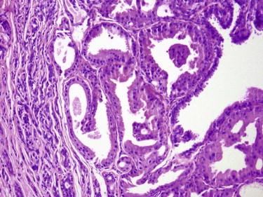 FIGURE 11-44, Apocrine adenoma. The inner epithelial cells show abundant pink cytoplasm and apocrine-type secretion.