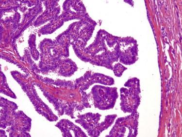 FIGURE 11-45, Hidradenoma papilliferum. Papillary epithelial projections with a fibrovascular core are seen in a cystic lumen.