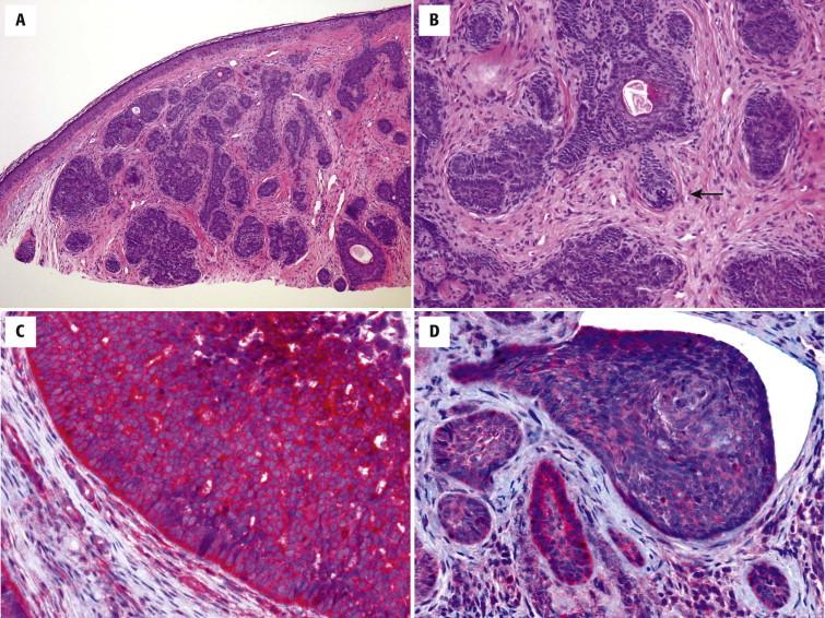 FIGURE 11-6, Trichoblastoma. A, Groups of basaloid cells surrounded by fibroblasts forming a fibroepithelial lesion. B, The basaloid cells show follicular features, including papillary mesenchymal bodies ( arrow ). C, Diffuse expression of PHLDA1. D, In contrast, basal cell carcinoma lacks PHLDA1 expression.