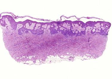 FIGURE 11-7, Trichoblastic proliferation overlying a dermatofibroma.