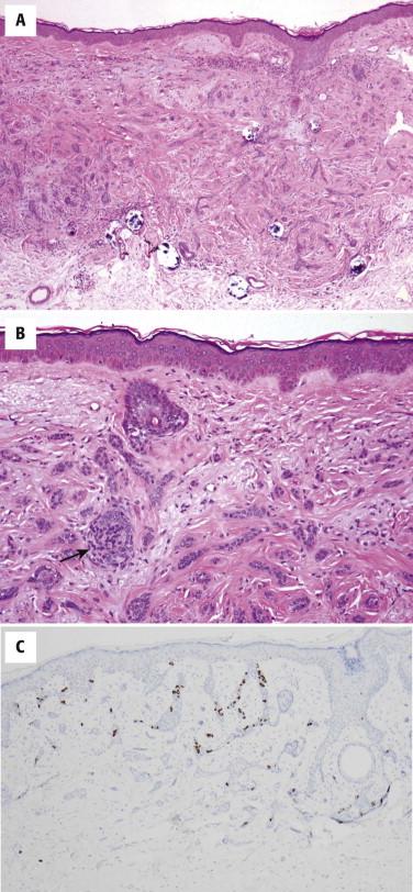 FIGURE 11-9, Desmoplastic trichoepithelioma. A, A plaque-like growth of thin cords of cytologically bland basaloid cells set in a sclerotic stroma with calcifications is present. B, A papillary mesenchymal body is identified (arrow). C, Several CK20-positive Merkel cells are seen in association with the basaloid strands.