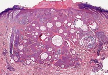 FIGURE 11-10, Trichoadenoma. Numerous keratocysts are present in the dermis.