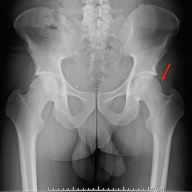 Fig. 42.1, Anteroposterior radiograph of the pelvis demonstrating the “pistol grip” deformity of the left femoral head-neck junction (red arrow) .