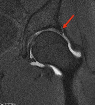 Fig. 42.2, Coronal magnetic resonance imaging cut demonstrating the solid white line traversing the otherwise black labrum denoting an intrasubstance tear (red arrow) .