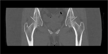 Fig. 42.3, Computed tomography image of measuring lateral center edge angles for the bilateral hips.