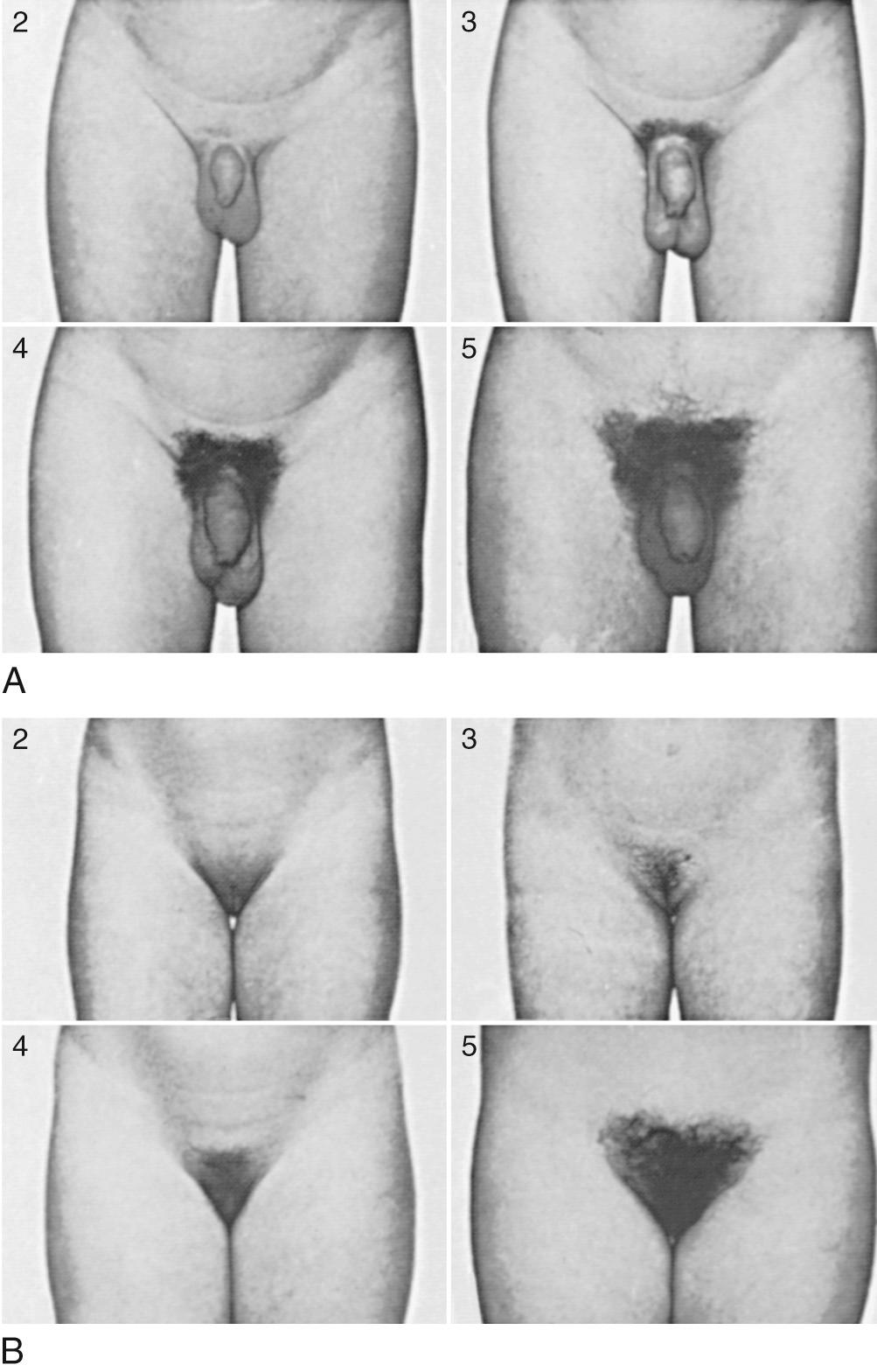 Fig. 132.1, Sexual maturity ratings (2-5) of pubic hair changes in adolescent males ( A ) and females ( B ) (see Tables 132.2 and 132.3 ).