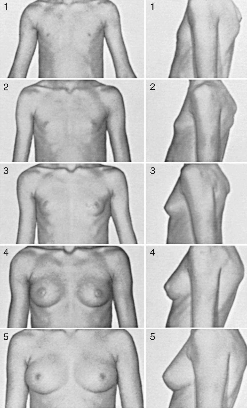 Fig. 132.2, Sexual maturity ratings (1-5) of breast changes in adolescent females.