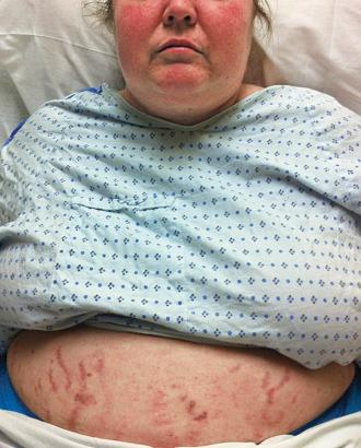 FIGURE 27-1, Moon facies and abdominal striae in a patient with Cushing syndrome.