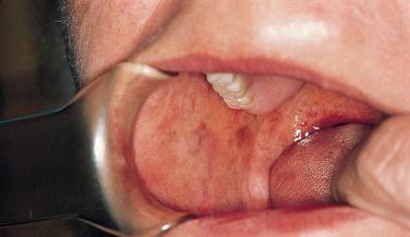 FIGURE 27-2, Pigmented macules on the buccal mucosa and lips in Addison disease.