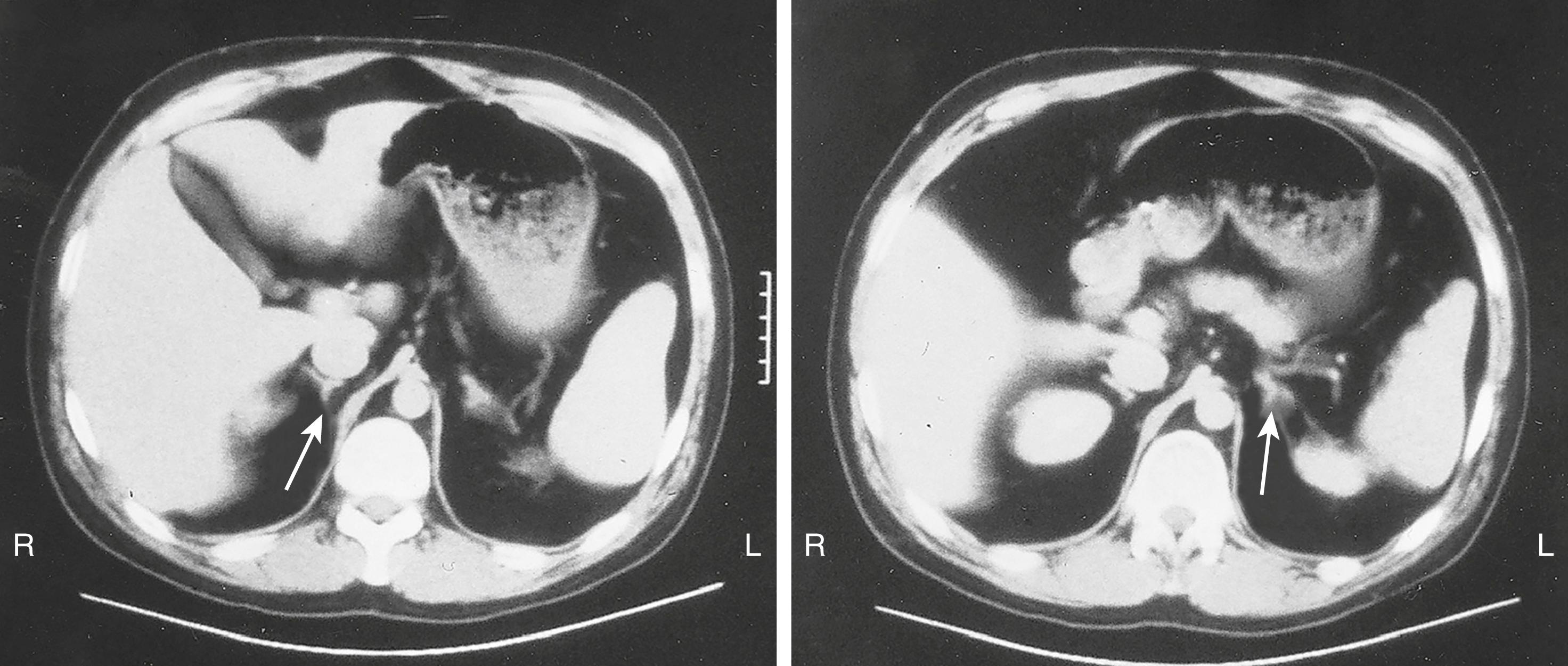 FIGURE 208-1, Magnetic resonance images of the abdomen showing the position and relative size of the normal adrenal glands.