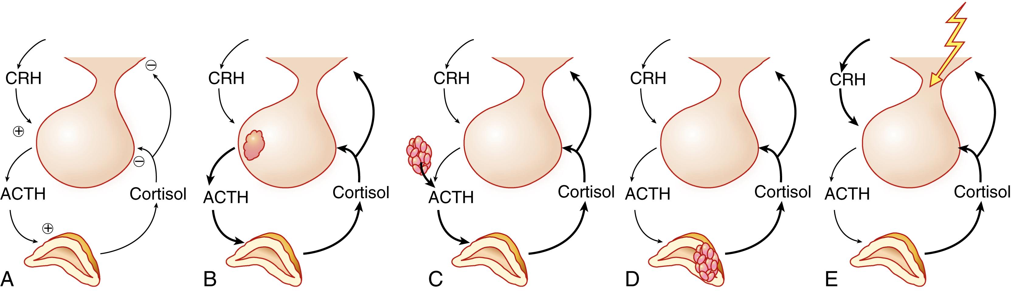 FIGURE 208-3, Physiology of the adrenal axis in health, Cushing syndrome, and pseudo-Cushing states.