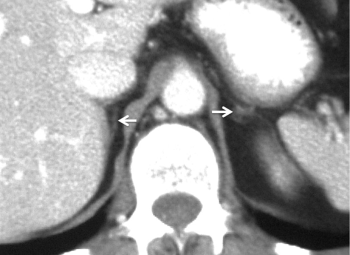 Contrast-enhanced CT 60 s after contrast medium administration. Both adrenal glands are very small, irregular and difficult to detect. The appearances are typical for autoimmune adrenal atrophy. **