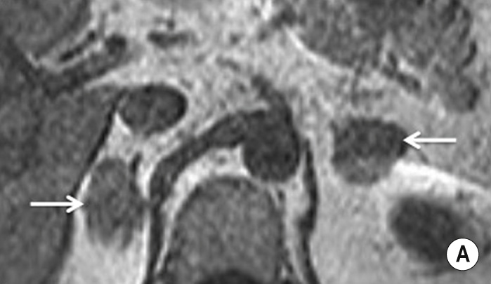 Bilateral adrenal masses. (A) Axial T1- and (B) axial T2-weighted images. Chemical shift imaging: (C) in-phase and (D) out-of-phase images. (E) Post-gadolinium enhanced T1-weighted image with fat saturation. Bilateral adrenal masses seen as homogeneous intermediate T1 signal intensity lesions, low T2 signal intensity and demonstrated rim enhancement following gadolinium administration. In (D), both drop significant visual signal intensity; all the parameters are in keeping with typical lipid-rich adenomas. **