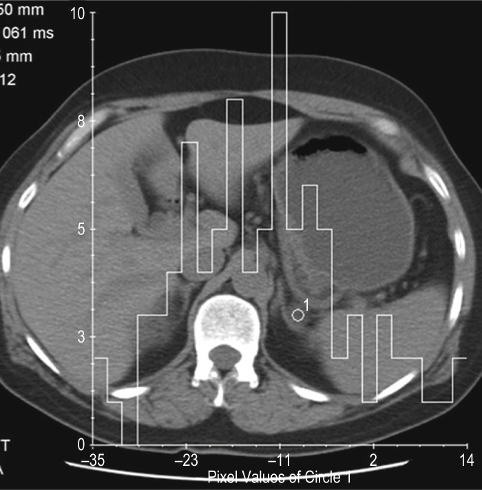 Histogram analysis of adenoma. A small left-sided adrenal lesion is seen on the unenhanced CT. The attenuation value is 14 HU and therefore indeterminate on unenhanced CT alone. On histogram analysis, obtained by drawing a region of interest over the mass, there are pixels ranging between –35 HU and +14 HU (x-axis). The presence of more than 5% negative pixels indicates an adenoma. This was confirmed on washout criteria. **