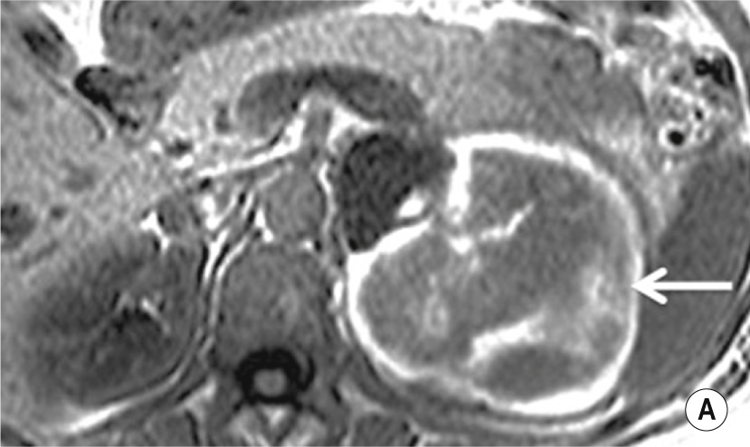 (A) Axial T1-, (B) coronal T2- and (C) coronal T1-weighted image with fat saturation and gadolinium enhancement of a sporadic large left adrenal haemorrhage in a 43-year-old man. There is a high T1 signal intensity rim, low T2 signal intensity foci within the lesion and no internal contrast enhancement. The lack of internal architecture and enhancement excludes an underlying lesion. **