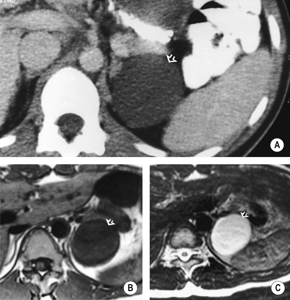 Adrenal cyst. (A) CECT showing the typical appearance of a cyst (arrow) within the left adrenal gland. (B) T1WI shows the low signal intensity of a simple cyst (arrow). (C) T2WI shows the uniformly high SI of a fluid-filled lesion (arrow). *