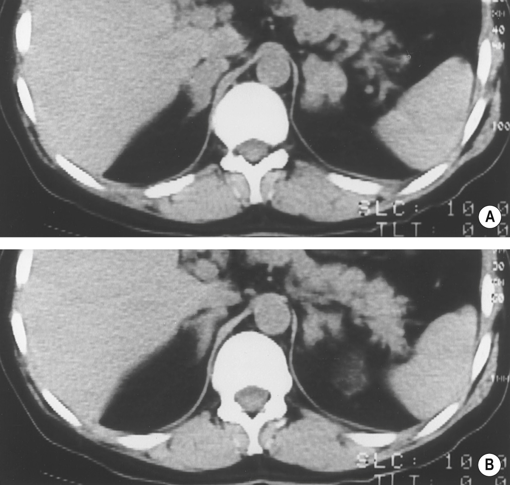 Adrenal metastases. (A) NECT demonstrates bilateral nodular adrenal masses. (B) After chemotherapy, the adrenal masses are smaller. ∫