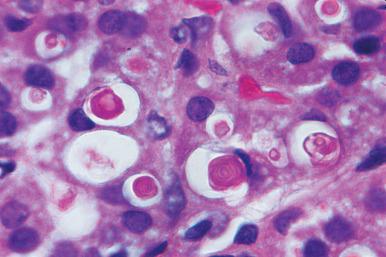 Figure 29.11, So-called spironolactone bodies. They appear as concentric laminated eosinophilic structures.