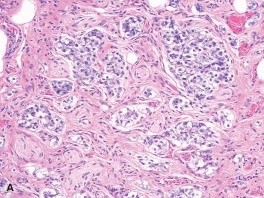 Figure 29.3, Normal paraganglion found incidentally in the retroperitoneal region. A, Hematoxylin–eosin; B, chromogranin.