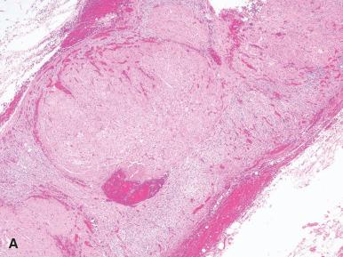 Figure 29.6, Primary pigmented nodular adrenal cortical hyperplasia. A, A micronodular pattern of growth is characteristic. B, Nodules are comprised of eosinophilic cells containing brown pigment.