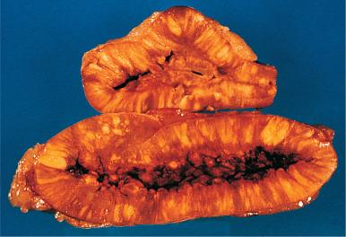 Figure 29.7, Adrenal cortical hyperplasia showing multinodular pattern of growth.