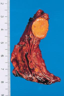 Figure 29.8, Gross appearance of adrenal cortical adenoma with single nodule, well-circumscribed growth, and typical golden yellow color.