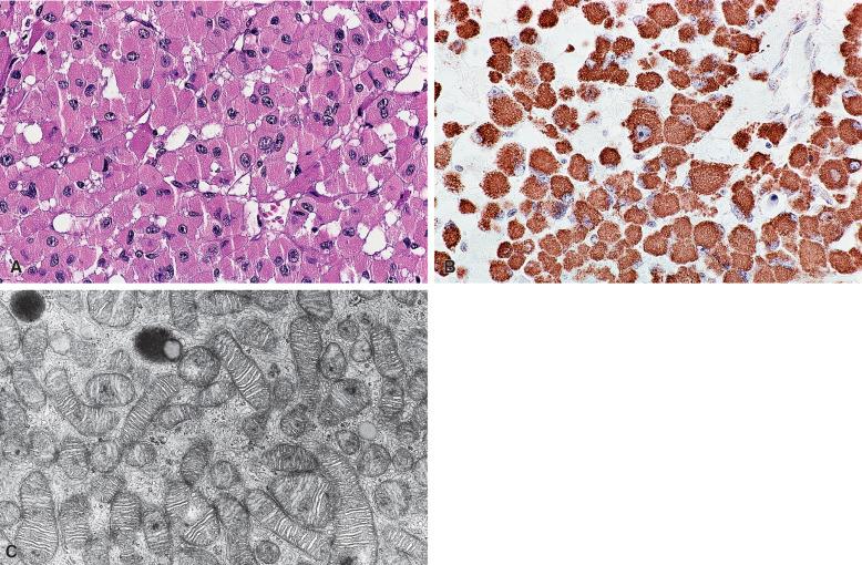 Figure 29.10, Adrenal oncocytoma. A, Hematoxylin–eosin; B, antimitochondrial immunostain; C, ultrastructural appearance. Numerous mitochondria with stacked tubulovesicular cristae, smooth endoplasmic reticulum, and two lysosomes are illustrated. (×31,200)