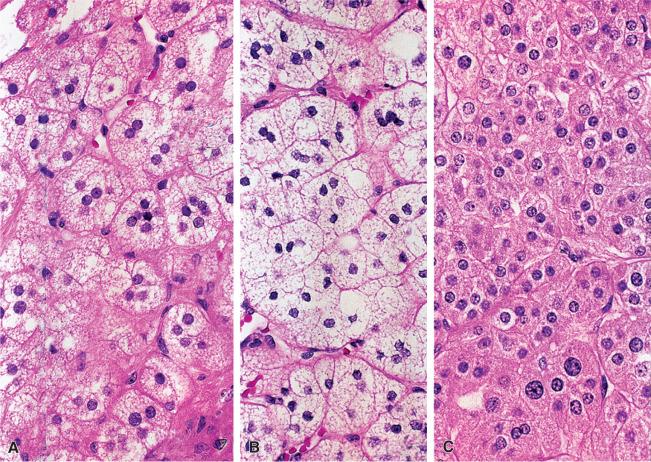 Figure 29.9, A–C, Various morphologic patterns within the same aldosterone-secreting adrenal cortical adenoma.