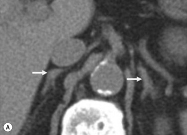 Fig. 37.1, (A) Unenhanced computed tomography (CT) of the adrenal glands. (B) Contrast-enhanced CT 60 seconds following contrast administration. (C) Coronal reconstruction of the postcontrast CT. Normal adrenal glands on CT with homogeneous appearances pre- and postcontrast administration. The adrenal body of each gland is demonstrated by the arrows and medial and lateral limbs by the double-ended arrows. (D) Contrast-enhanced CT 30 seconds following contrast administration demonstrating the adrenal arteries (arrows).