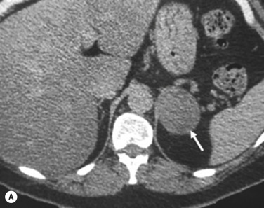 Fig. 37.4, (A) Unenhanced computed tomography (CT) of a patient undergoing investigations for adrenocorticotrophic hormone-independent Cushing's syndrome. A 4.5-cm left adrenal mass is demonstrated (arrows) with a smooth contour and an attenuation value of 13 HU. On CT this is an indeterminate mass. The right adrenal gland is suppressed and small. (B) T 2 weighted magnetic resonance imaging shows the lesion is heterogeneous, raising the likelihood of an adrenal carcinoma. The lesion was surgically confirmed as a malignant adrenocortical carcinoma with a high Ki67 proliferative index.