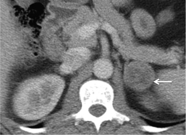 Fig. 37.5, Post-Intravenous Contrast-Enhanced Computed Tomography of the Adrenal Glands.