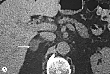 Fig. 37.6, (A) Unenhanced computed tomography (CT) showing a 2-cm solid right adrenal incidental lesion (arrow) with attenuation value of 6 HU in keeping with a benign lipid-rich adenoma. If the adenoma has no associated biochemical function, no further imaging or follow-up would be required. (B) Post-intravenous (IV) contrast CT 60 seconds after IV contrast administration shows the lesion enhancing with a CT attenuation value of 80 HU. (C) CT 15 minutes after IV contrast administration shows the lesion (arrow) with a CT attenuation value of 22 HU. This provides an absolute contrast washout of 78%, in keeping with a benign adenoma.