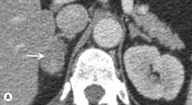 Fig. 37.7, (A) Post-intravenous (IV) contrast computed tomography, 60 seconds following contrast administration. (B) Post-IV contrast, 15 minutes following contrast administration. A right adrenal mass (arrow) is incidentally detected with a postcontrast attenuation value of 100 HU. After 15 minutes, the delayed images show the mass has an attenuation value of 32 HU. The relative washout is, therefore, 68% consistent with an adenoma.