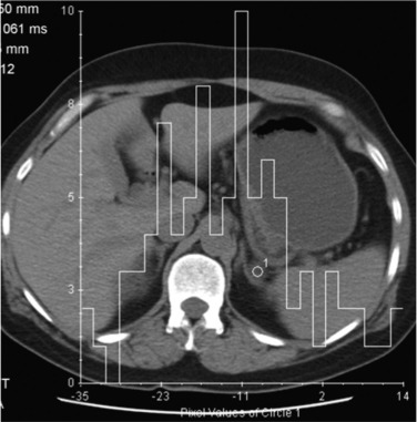 Fig. 37.8, Histogram Analysis of Adenoma.