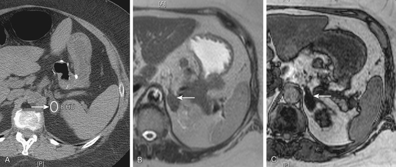 Figure 71-1, Unenhanced axial computed tomography (CT) (A) and axial magnetic resonance (B) in-phase and out-of-phase (C) images in a 42-year-old woman demonstrate a small low-density (8 Hounsfield units) left adrenal lesion (arrow) on CT that is isointense to hypointense as compared with spleen on in-phase imaging with significant drop out of signal on out-of-phase imaging, suggestive of microscopic fat within the lesion. These features are consistent with an adenoma.