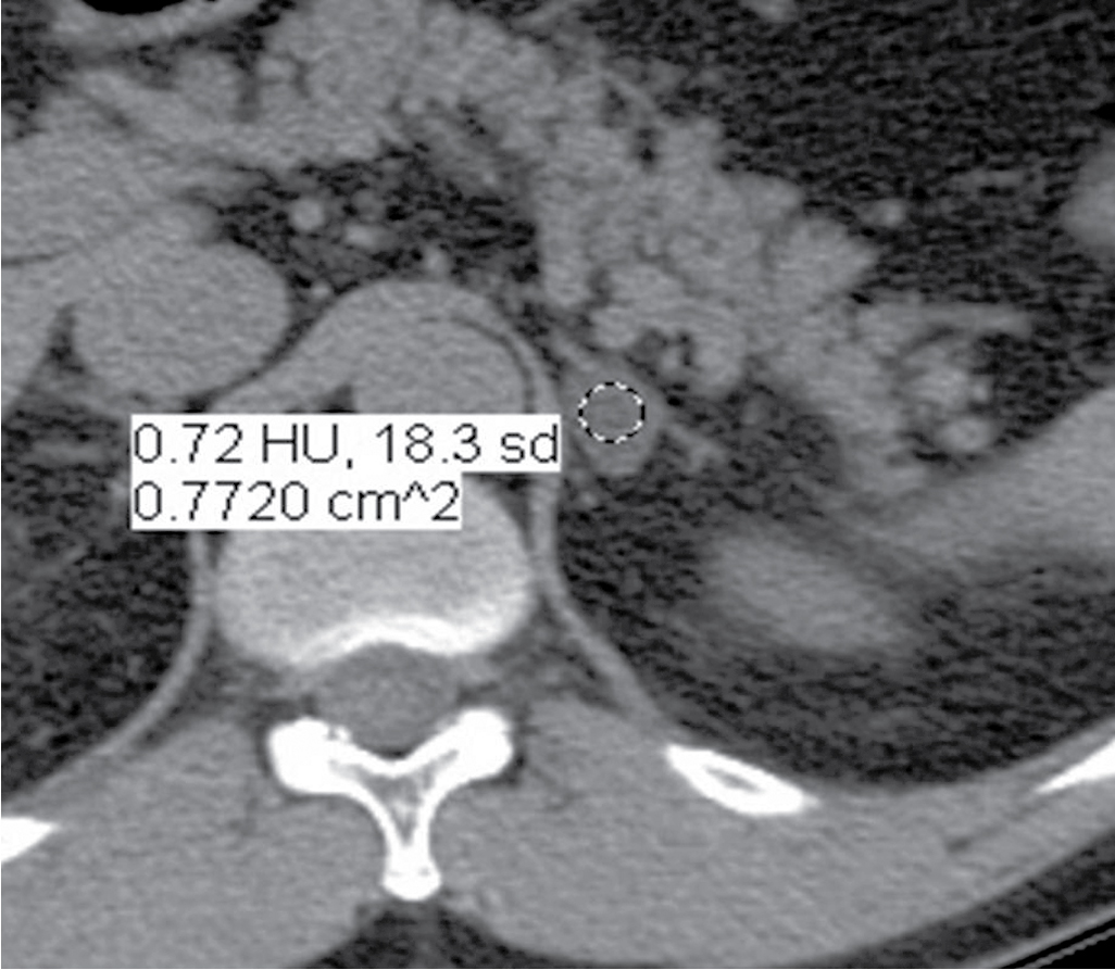 Fig. 28.2, An incidentally discovered left adrenal nodule has measured attenuation values of less than 10 Hounsfield units on unenhanced imaging. This is consistent with a lipid-rich adenoma.