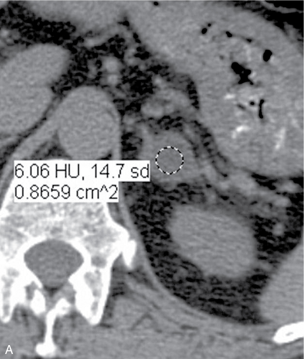 Fig. 28.3, Contrast material washout in an adrenal adenoma. A, Unenhanced computed tomography (CT) scan shows a homogeneous low-attenuation adrenal nodule with attenuation of 6 Hounsfield units (HU) (typical of a lipid-rich adenoma). B, On the portal venous phase of contrast enhancement, the nodule enhances with attenuation values of 86 HU. C, On 15-minute-delayed CT, the mass has decreased enhancement with attenuation of 32 HU. The contrast enhancement during the portal venous phase washed out by 68% by the time of the delayed scans, confirming that this is an adenoma. Absolute washout of 60% or greater is diagnostic of an adenoma.